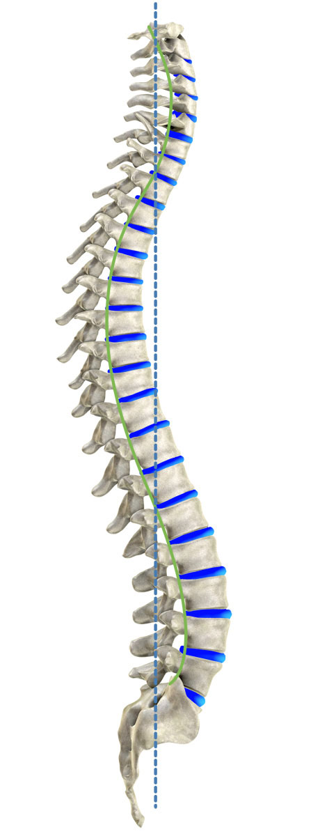 Kyphosis [image]