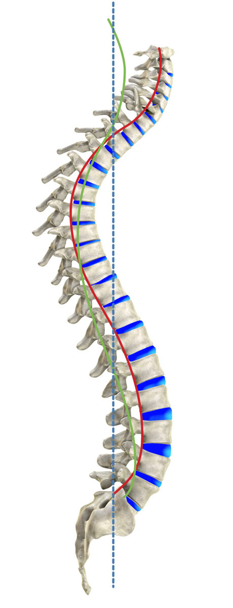 Kyphosis [image]