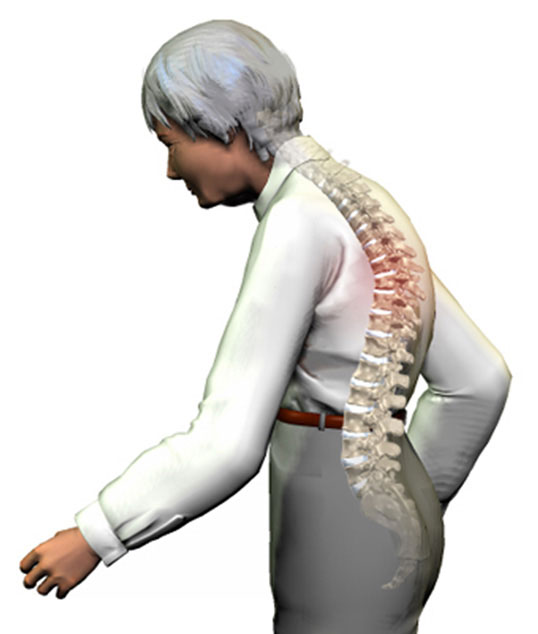 ADULT HYPERKYPHOSIS