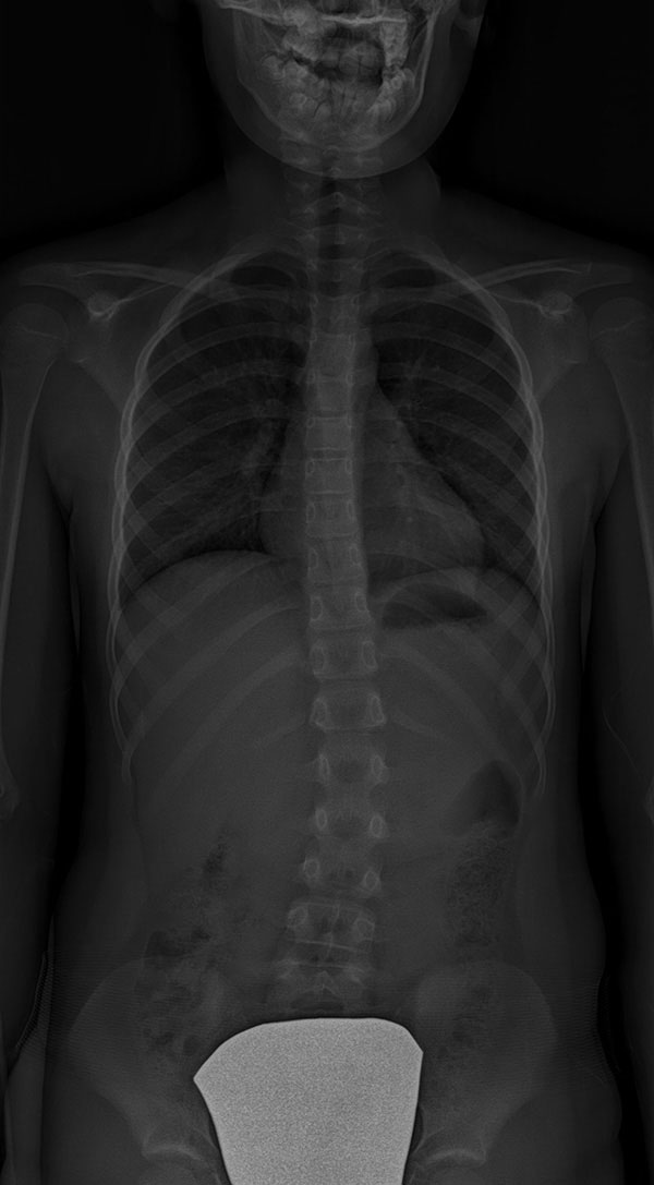 Scoliosis