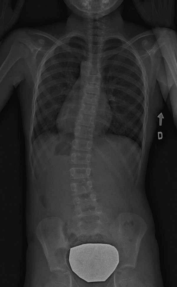 Scoliosis