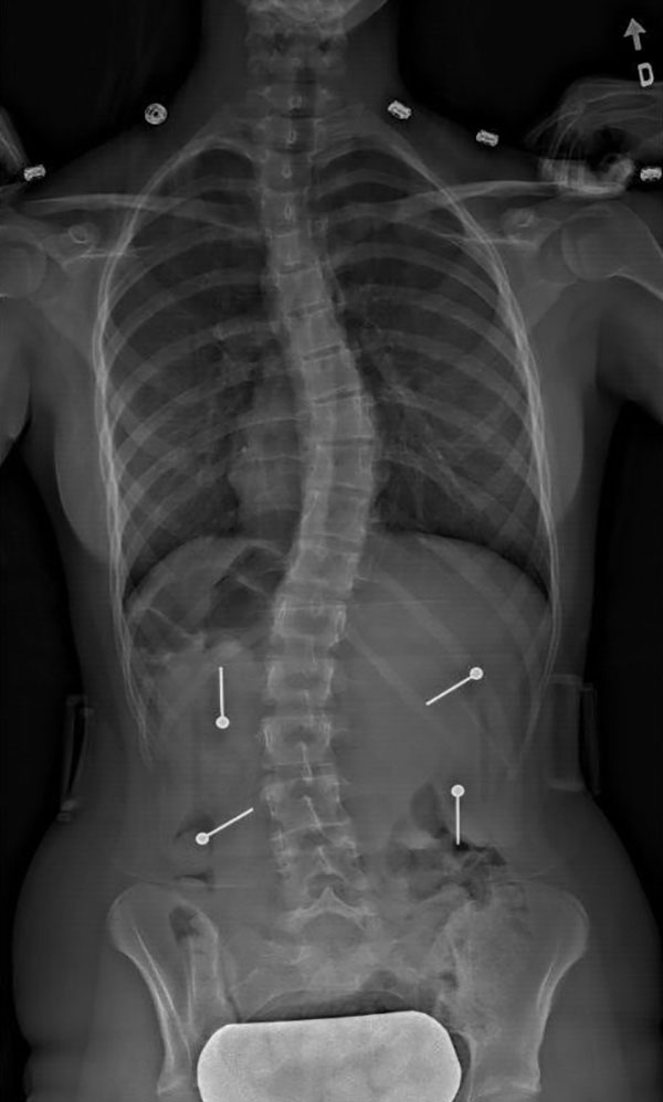 Scoliosis