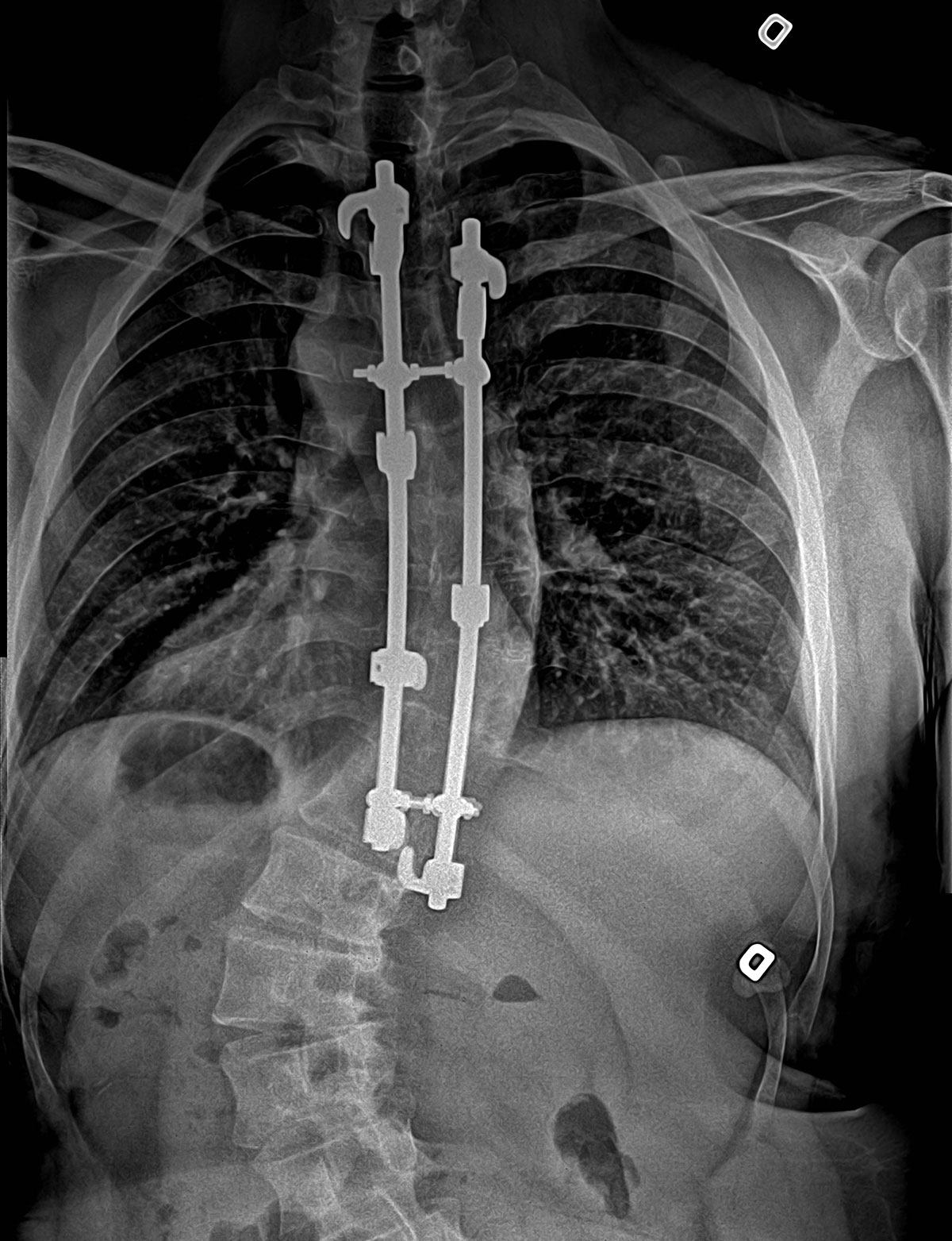 Treating scoliosis